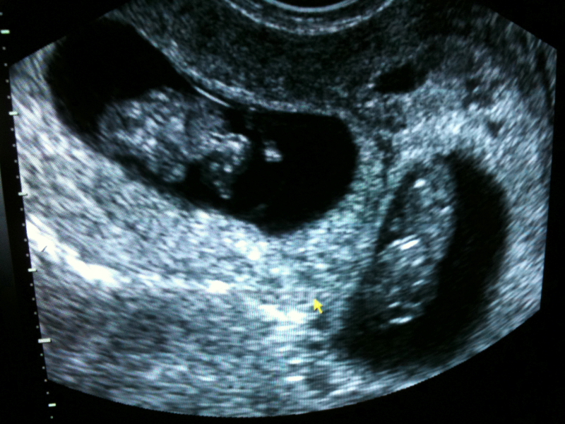 Nőgyógyászati ultrahang mit mutat ki